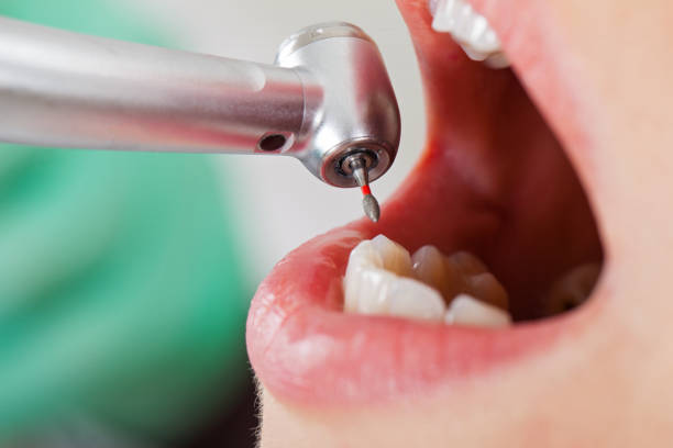 Best Emergency Dentist for Knocked-Out Tooth in Fort Llins, CO